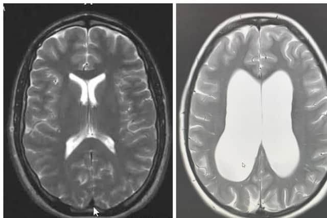 The picture shows what a brain should look like on the left and Emma's on the right which shows a significant difference