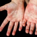 Red rash on the hands of the palms of the child, rubella scarlet fever Coxsackie and other infectious viral diseases in children and adults