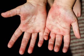 Red rash on the hands of the palms of the child, rubella scarlet fever Coxsackie and other infectious viral diseases in children and adults