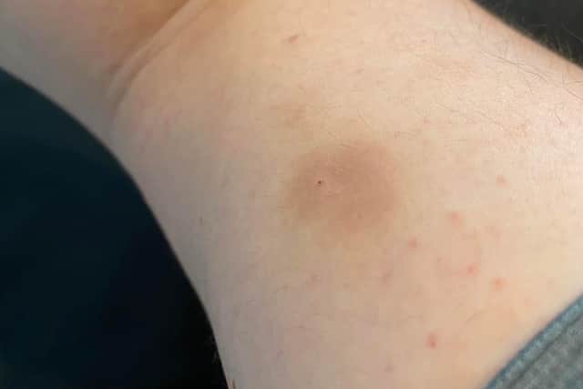 Sam Durning, from Lytham, fears he was 'spiked by needle' after blacking out and finding a jab mark on his arm the next morning