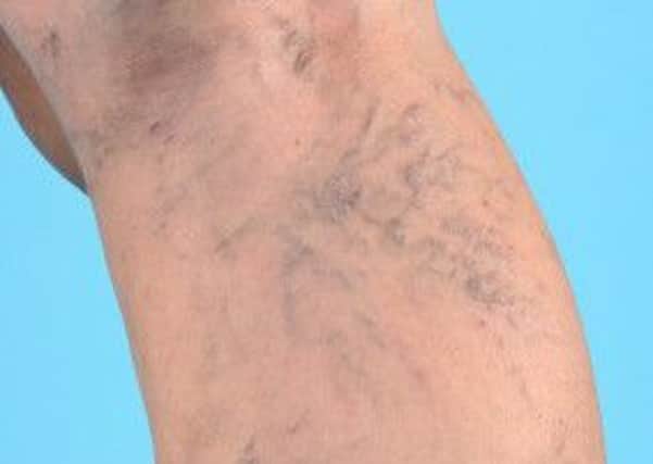 Stock image of varicose veins