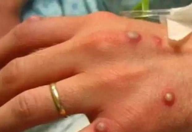 Monkeypox scare as Blackpool Victoria Hospital staff vaccinated