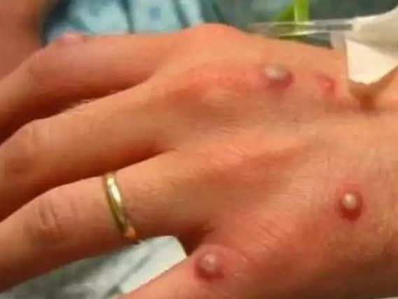 Monkeypox scare as Blackpool Victoria Hospital staff vaccinated
