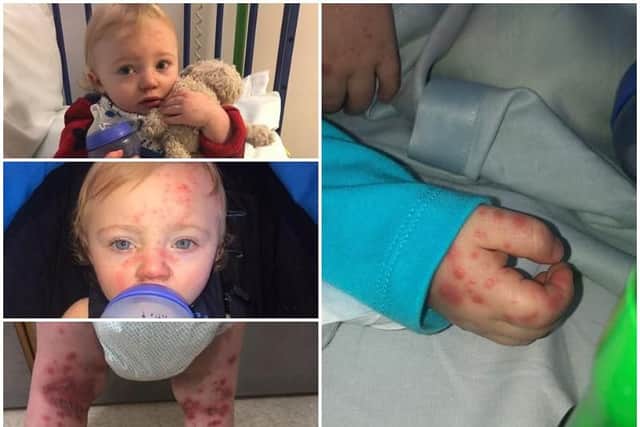 Laaston Ogden, from Poulton, was thought to be coming down with chicken pox - but had in fact been infected with herpes. The virus is mostly harmless for adults, but can be dangerous for babies. Pictures by mum Louise Ogden