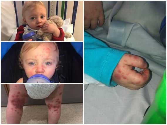 Laaston Ogden, from Poulton, was thought to be coming down with chicken pox - but had in fact been infected with herpes. The virus is mostly harmless for adults, but can be dangerous for babies. Pictures by mum Louise Ogden