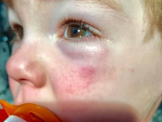 Two-year-old Carter Hinds is said to have suffered a swollen eye