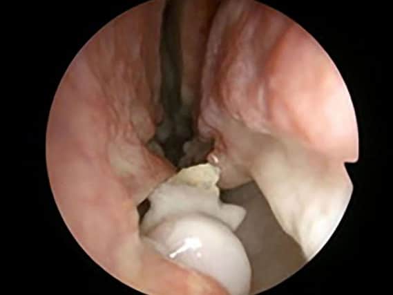 Picture taken, by an endoscope, of a tooth before it was extracted by doctors in Denmark from inside the nostril of a 59-year-old man, who had complained of nasal congestion problems and loss of his sense of smell.