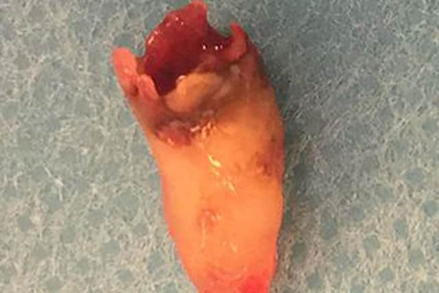 Tooth extracted by doctors in Denmark from inside the nostril of a 59-year-old man, who had complained of nasal congestion problems and loss of his sense of smell.