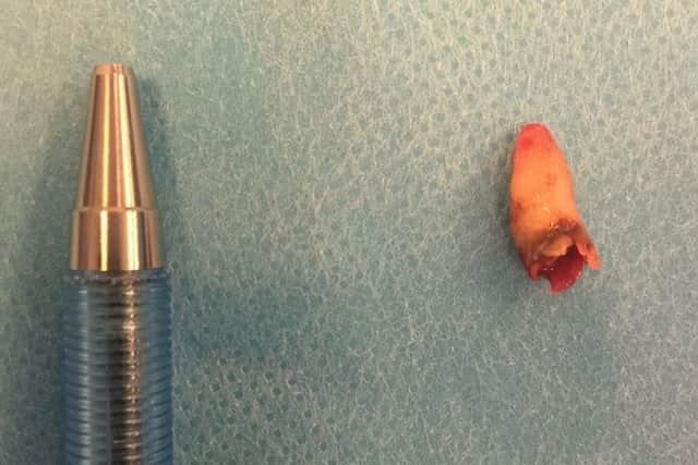 Tooth, shown next to a pen for scale, extracted by doctors in Denmark from inside the nostril of a 59-year-old man, who had complained of nasal congestion problems and loss of his sense of smell.