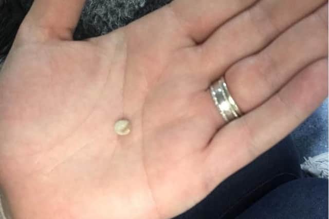 The kidney stone which Millie passed