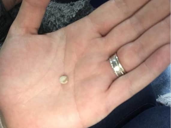 The kidney stone which Millie passed