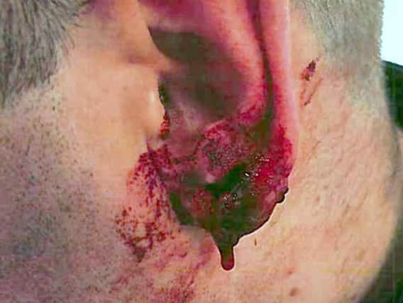 Police officer's ear which was bitten by Daniel Ward, 26, of Norton Hill, Runcorn, who bit a hole in the officer's ear as he attempted to evade arrest. Ward has been jailed at Chester Crown Court on Monday and jailed for 13 years, with an extended licence period of four years.
