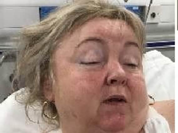 Holidaymaker Lorraine Lawson spent six days in intensive care in Blackpool after the incident after fracturing her skull in the horrific incident