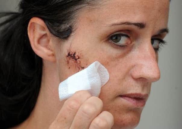 Needing stitches: Becky Porter from Poulton was glassed by a woman while 
out drinking