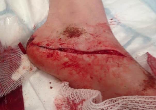Emmalee McCormick, 10, sliced her foot open on a discarded barbecue on Fleetwood Beach