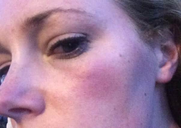 Sarah Ginley was hit in the face by an egg thrown from a passing car.