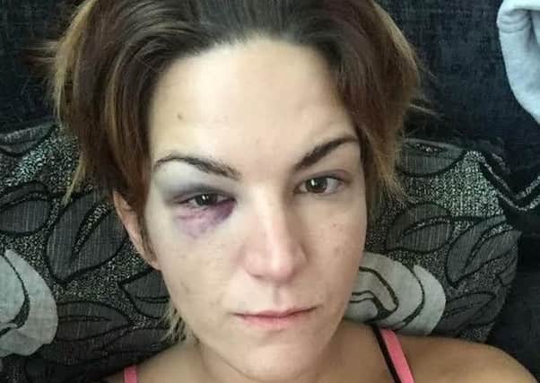 Rebecca Tilford was left with a black eye after her abusive pertner Louis Shelton pushed her down the stairs and started to punch and kick her
