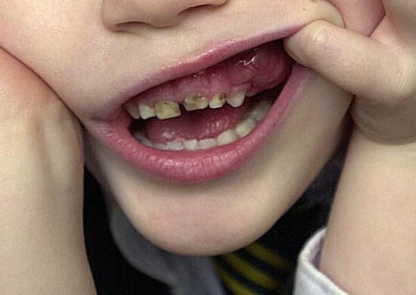Dental health among Blackpools youngsters is poor according to council leaders