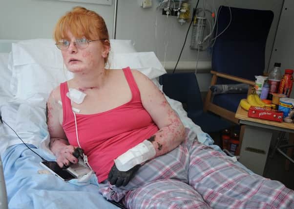 WARNING GRAPHIC CONTENT- Blackpool mum of two Charly Babington is set to undergo a gruelling triple amputation after contracting severe sepsis.  PIC BY ROB LOCK
16-8-2016