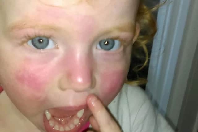 Martha Byrnes face was covered in a painful rash after using the wipes. Credit: SWNS