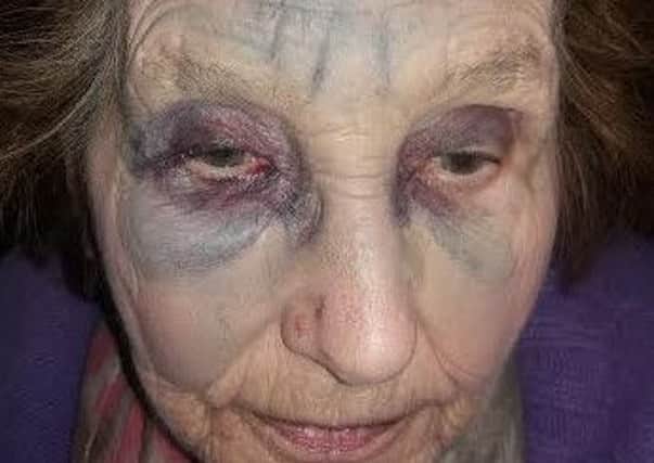 78 year old Joyce Holden after she was punched in the face in the street